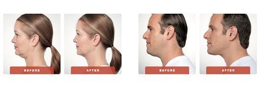 Upper neck outlet fat